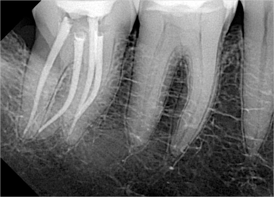 Endodoncia avanzada