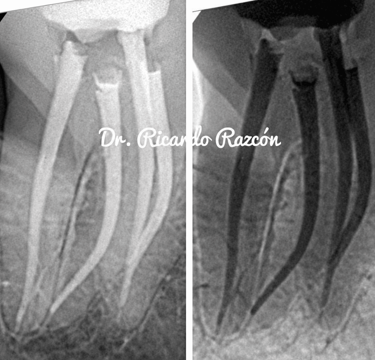 Endodoncia avanzada